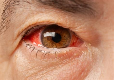 blood leaking from eye|Retinal Bleeding: Symptoms, Causes, Diagnosis, and。